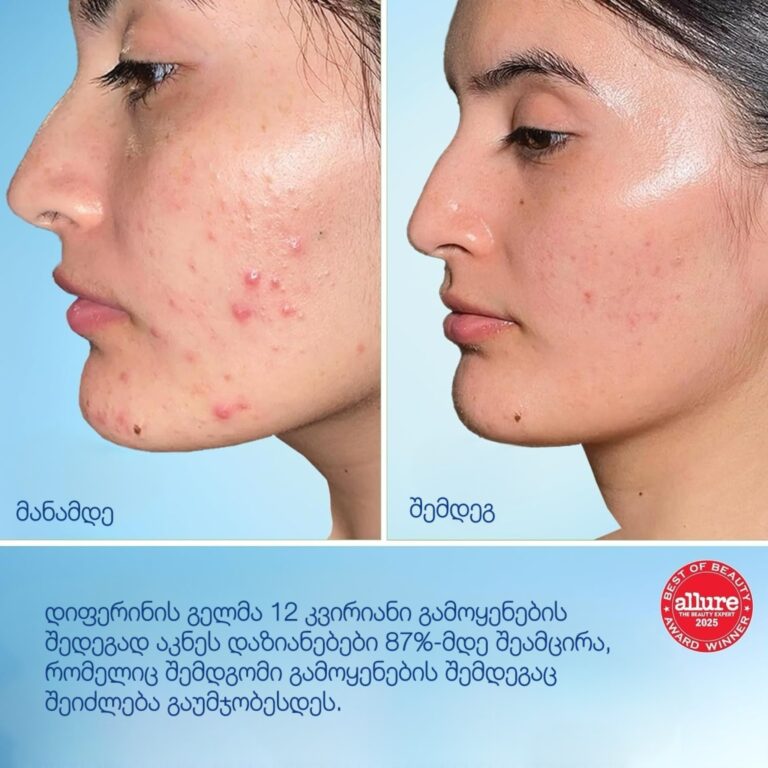 differin დიფერინი ადაპალენი